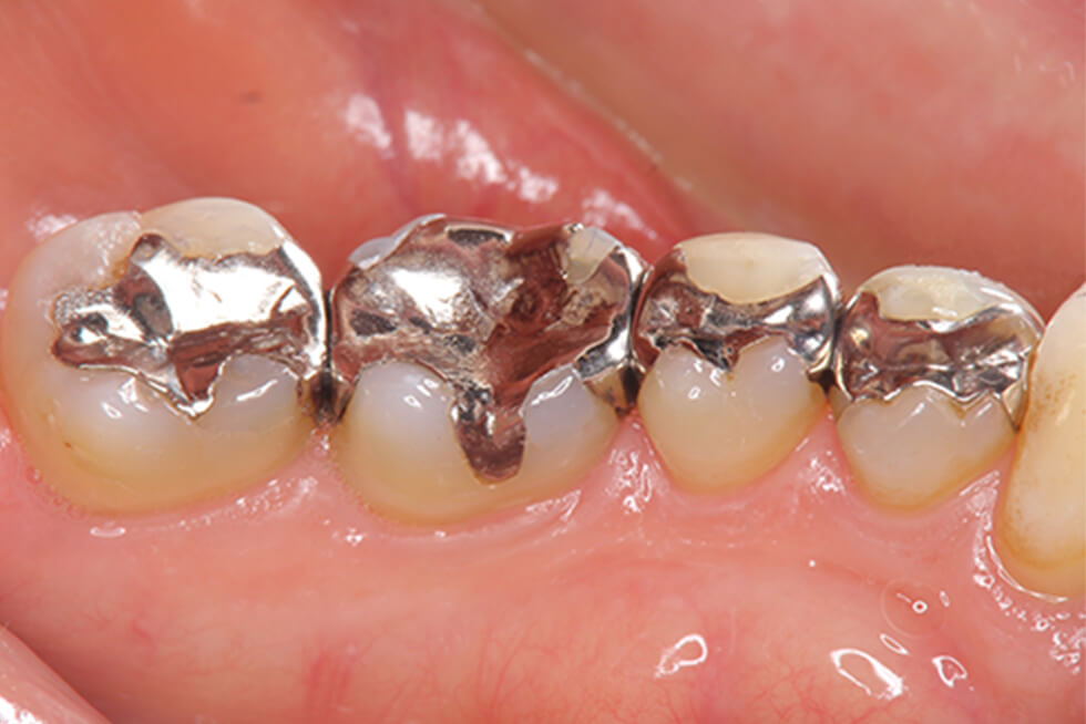 金属の詰め物・被せ物（銀歯など）による治療箇所を、より自然で美しく修復