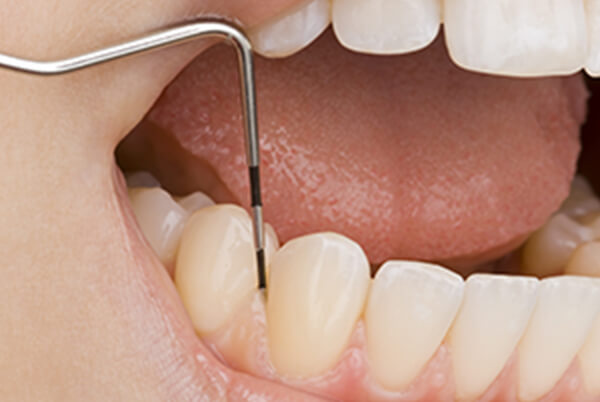 歯周病検査・基本治療