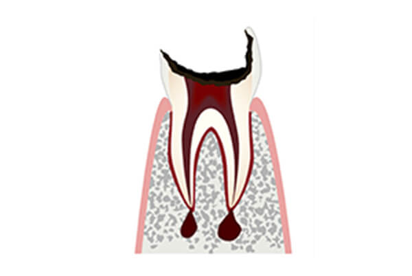 C4 歯根の虫歯